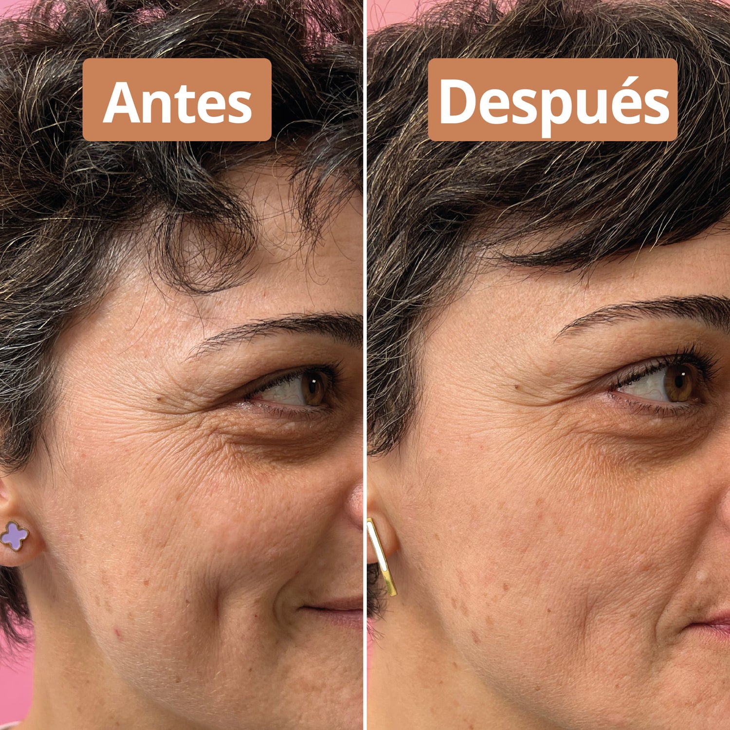 antes después anti edad