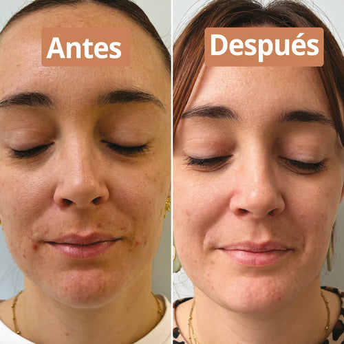 antes después purificante