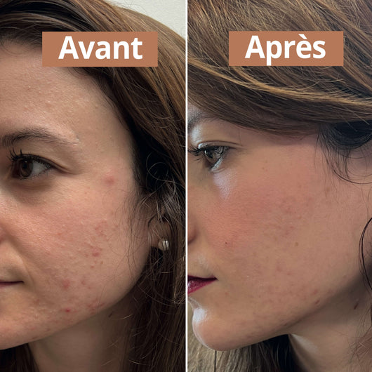 avant après de la routine imperfections comme avant 